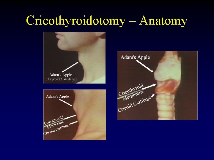 Cricothyroidotomy – Anatomy 