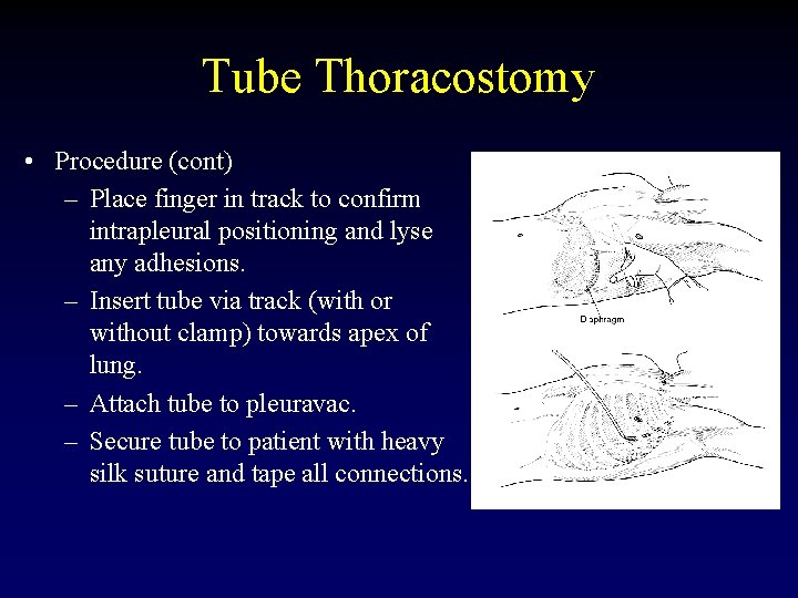 Tube Thoracostomy • Procedure (cont) – Place finger in track to confirm intrapleural positioning