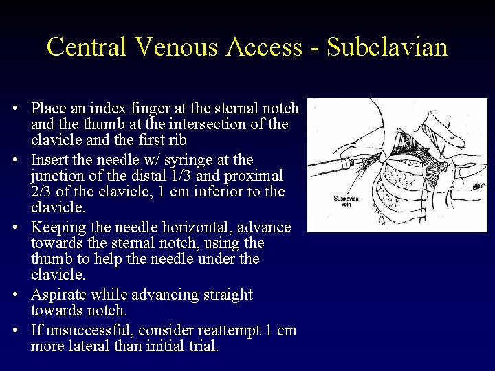 Central Venous Access - Subclavian • Place an index finger at the sternal notch