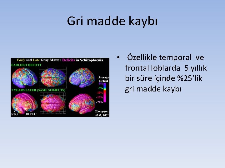 Gri madde kaybı • Özellikle temporal ve frontal loblarda 5 yıllık bir süre içinde