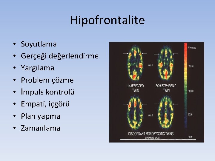 Hipofrontalite • • Soyutlama Gerçeği değerlendirme Yargılama Problem çözme İmpuls kontrolü Empati, içgörü Plan