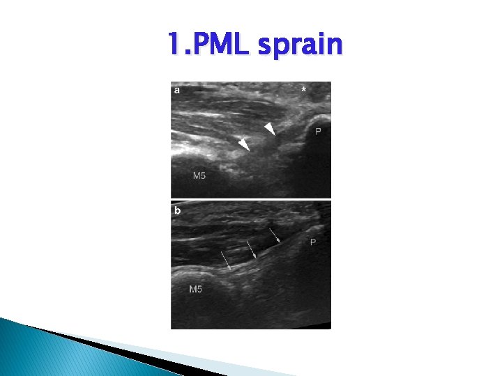 1. PML sprain 