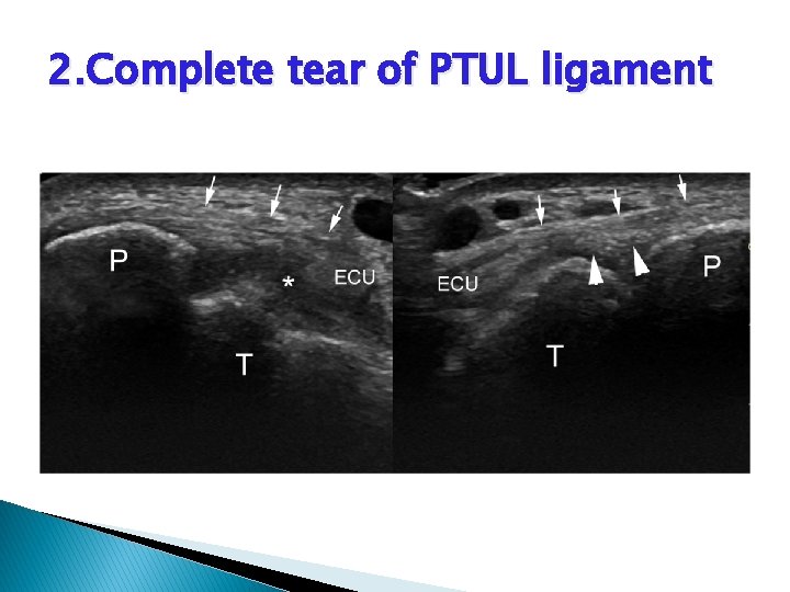 2. Complete tear of PTUL ligament 