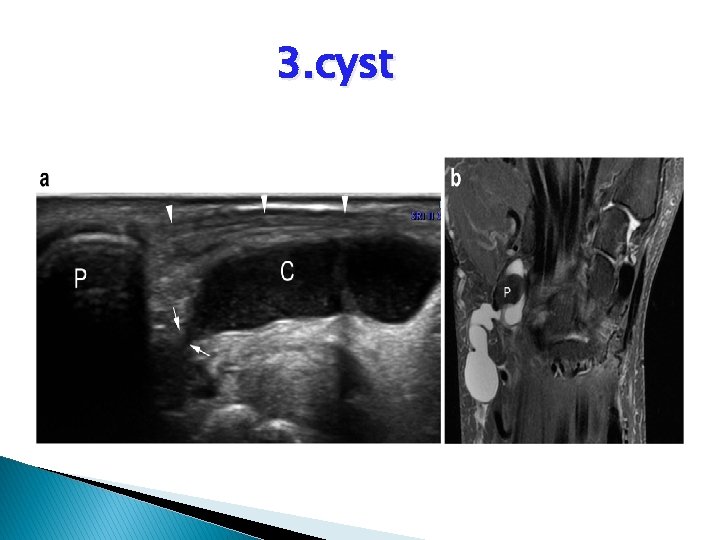 3. cyst 