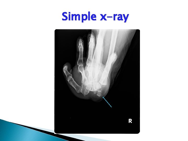 Simple x-ray 