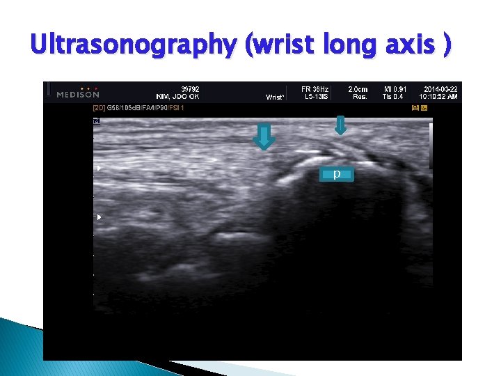 Ultrasonography (wrist long axis ) p 
