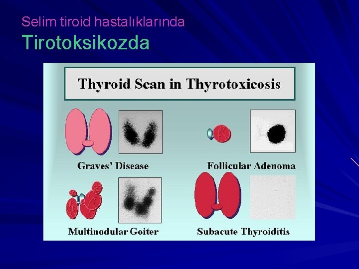 Selim tiroid hastalıklarında Tirotoksikozda 