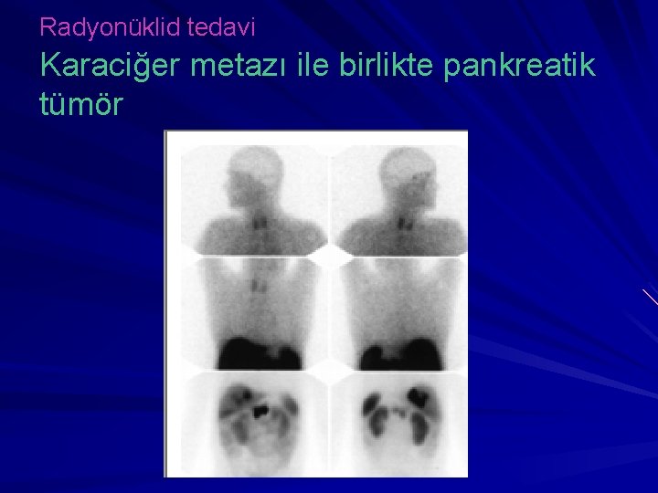 Radyonüklid tedavi Karaciğer metazı ile birlikte pankreatik tümör 