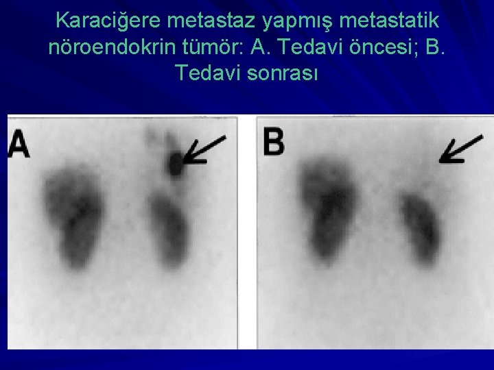 Karaciğere metastaz yapmış metastatik nöroendokrin tümör: A. Tedavi öncesi; B. Tedavi sonrası 