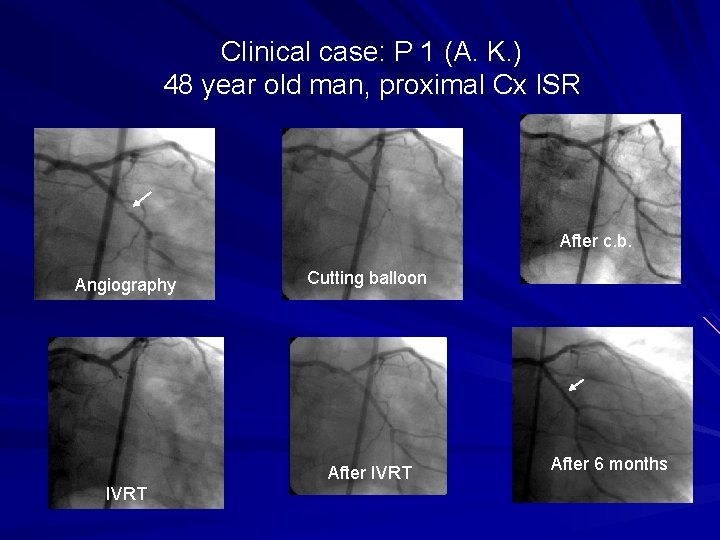 Clinical case: P 1 (A. K. ) 48 year old man, proximal Cx ISR