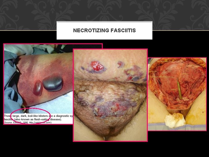 NECROTIZING FASCIITIS 