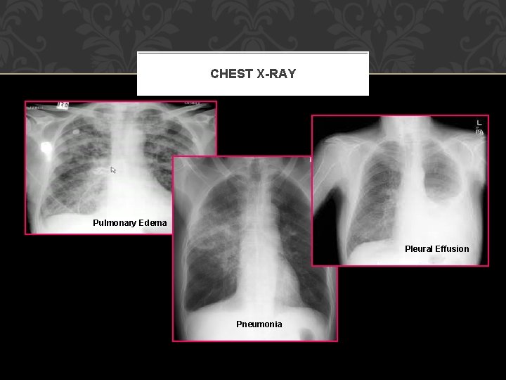 CHEST X-RAY Pulmonary Edema Pleural Effusion Pneumonia 