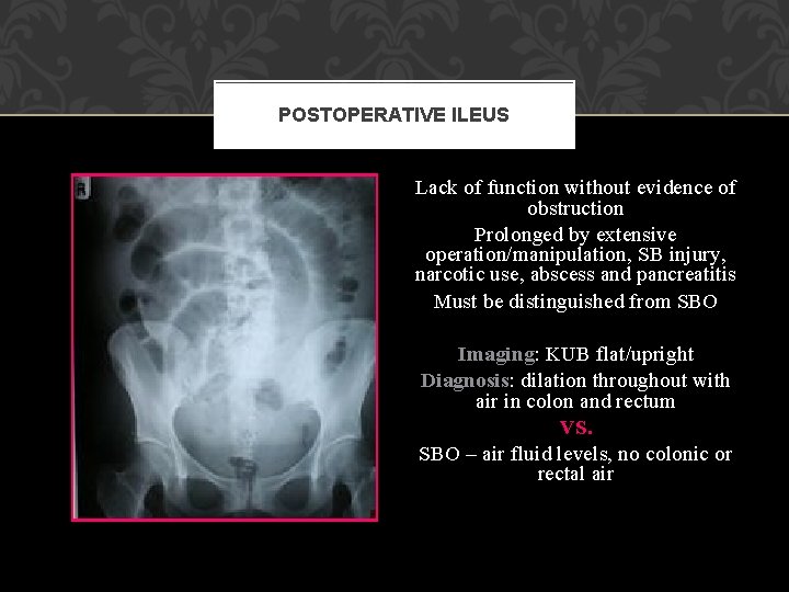 POSTOPERATIVE ILEUS Lack of function without evidence of obstruction Prolonged by extensive operation/manipulation, SB