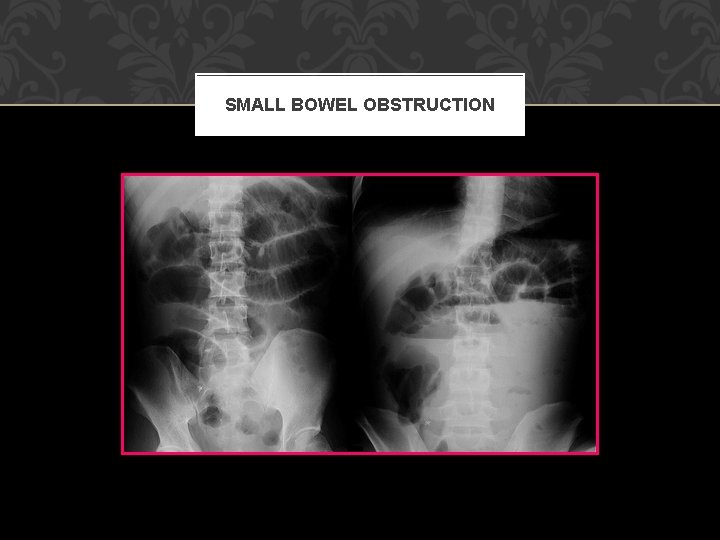 SMALL BOWEL OBSTRUCTION 