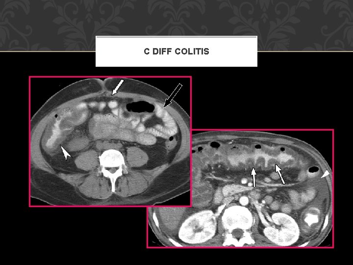 C DIFF COLITIS 