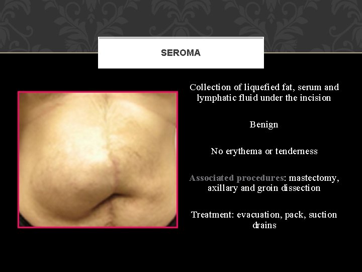 SEROMA Collection of liquefied fat, serum and lymphatic fluid under the incision Benign No