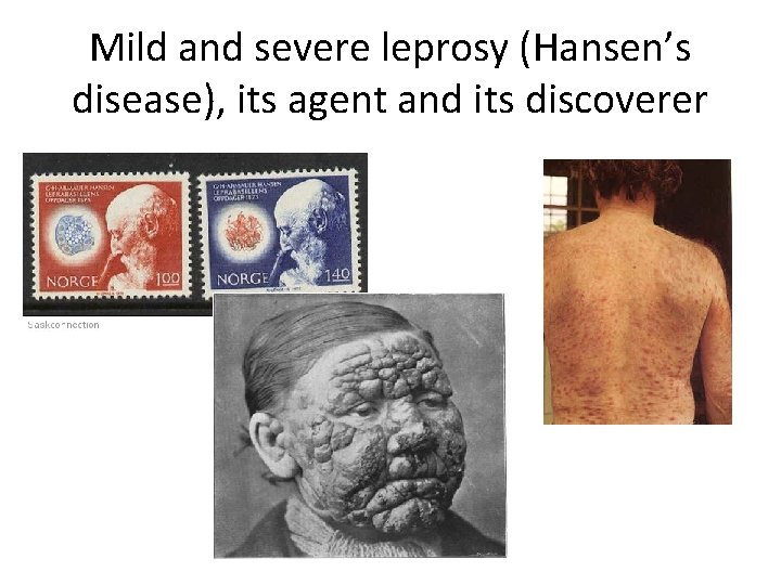 Mild and severe leprosy (Hansen’s disease), its agent and its discoverer 