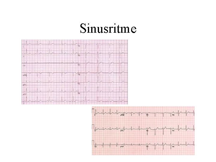 Sinusritme 