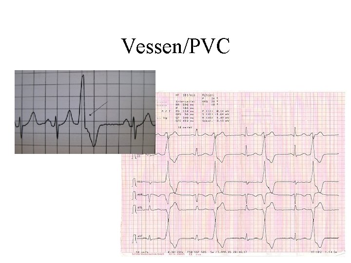 Vessen/PVC 