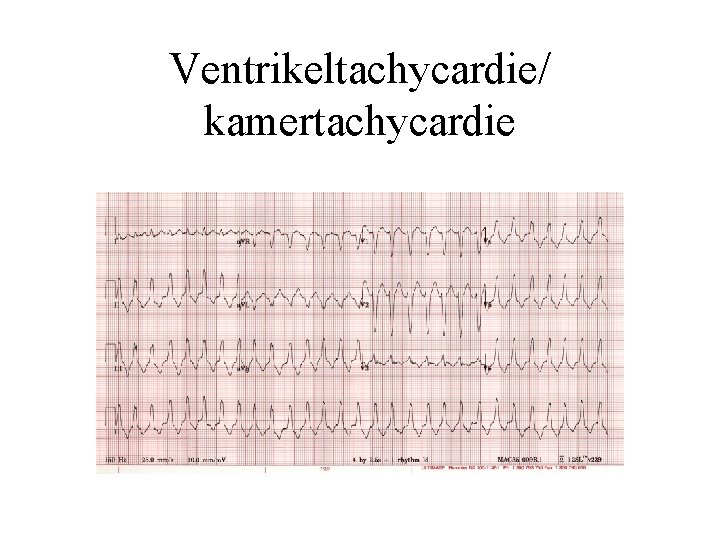 Ventrikeltachycardie/ kamertachycardie 