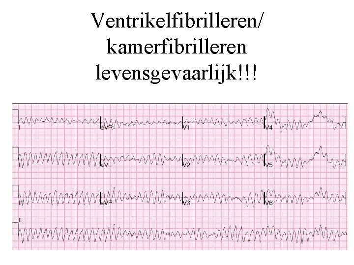 Ventrikelfibrilleren/ kamerfibrilleren levensgevaarlijk!!! 