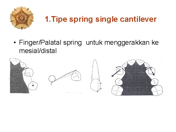 1. Tipe spring single cantilever • Finger/Palatal spring untuk menggerakkan ke mesial/distal 