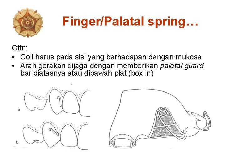 Finger/Palatal spring… Cttn: • Coil harus pada sisi yang berhadapan dengan mukosa • Arah