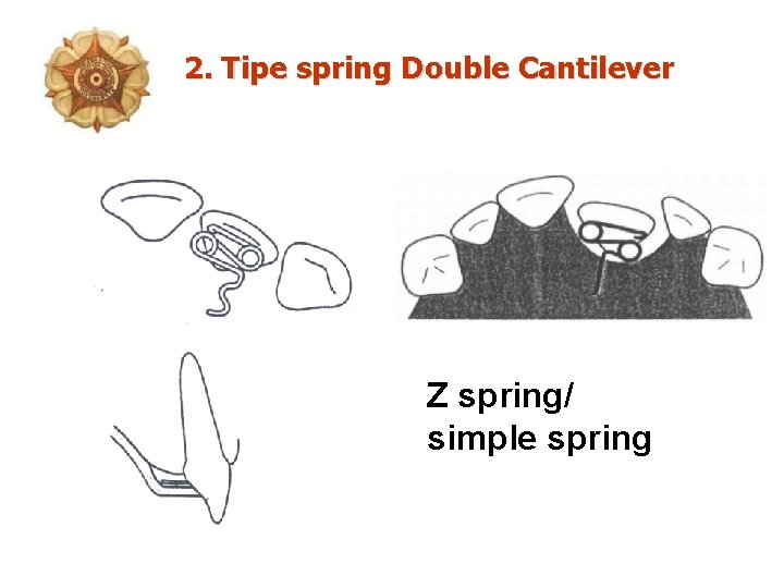 2. Tipe spring Double Cantilever Z spring/ simple spring 