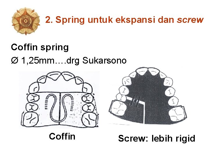 2. Spring untuk ekspansi dan screw Coffin spring Ø 1, 25 mm…. drg Sukarsono