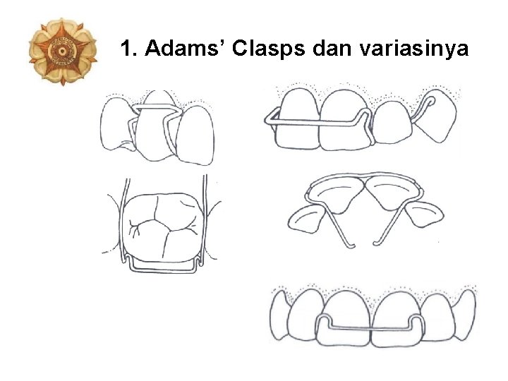 1. Adams’ Clasps dan variasinya 