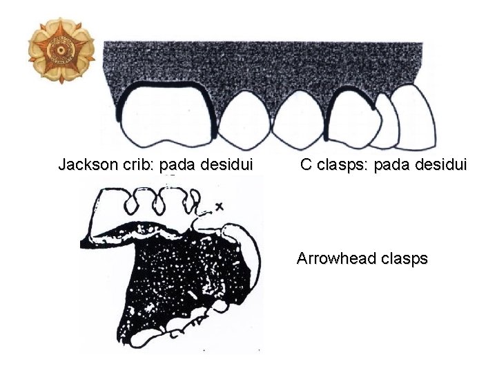 Jackson crib: pada desidui C clasps: pada desidui Arrowhead clasps 