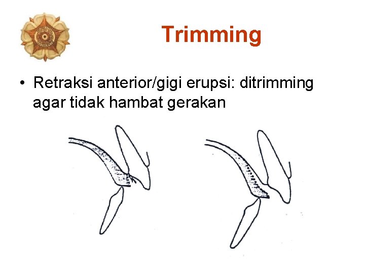 Trimming • Retraksi anterior/gigi erupsi: ditrimming agar tidak hambat gerakan 