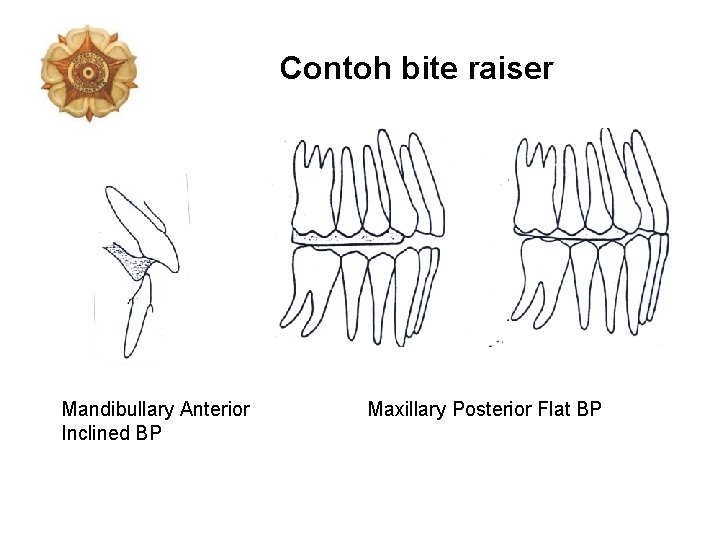 Contoh bite raiser Mandibullary Anterior Inclined BP Maxillary Posterior Flat BP 