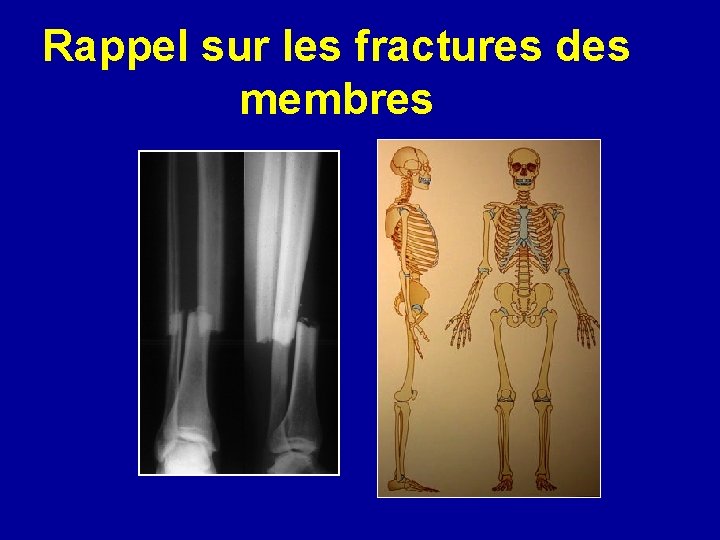 Rappel sur les fractures des membres 