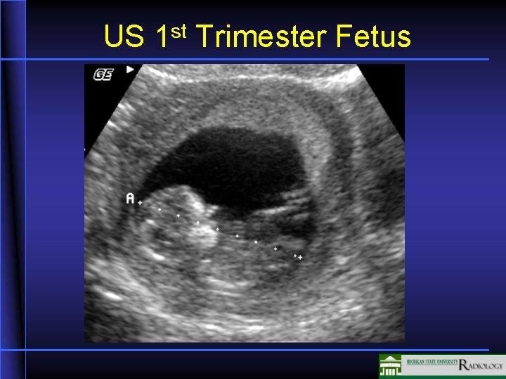 US 1 st Trimester Fetus 