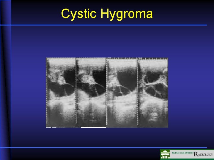 Cystic Hygroma 