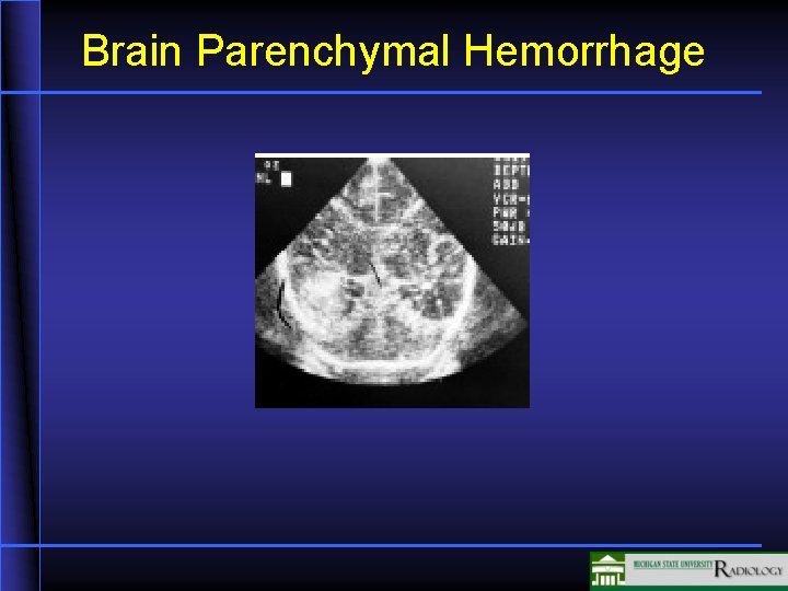 Brain Parenchymal Hemorrhage 