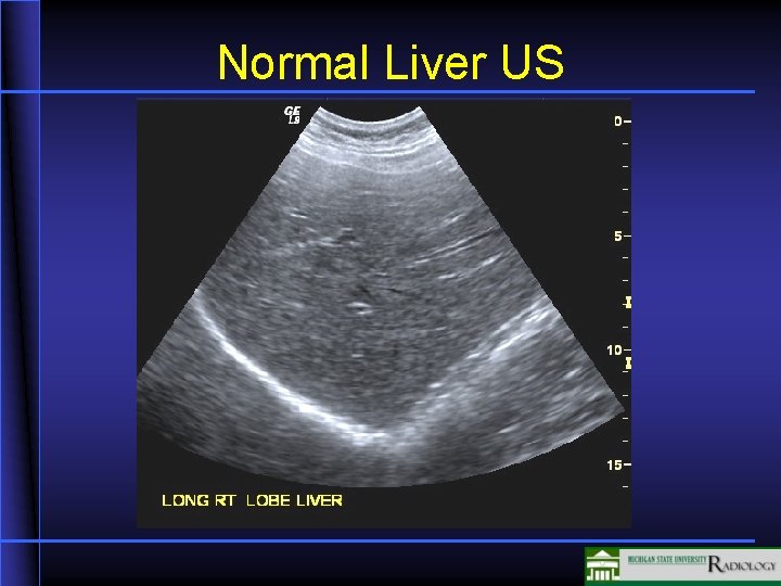 Normal Liver US 