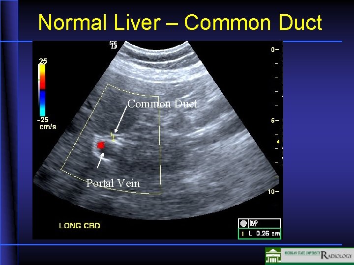 Normal Liver – Common Duct Portal Vein 