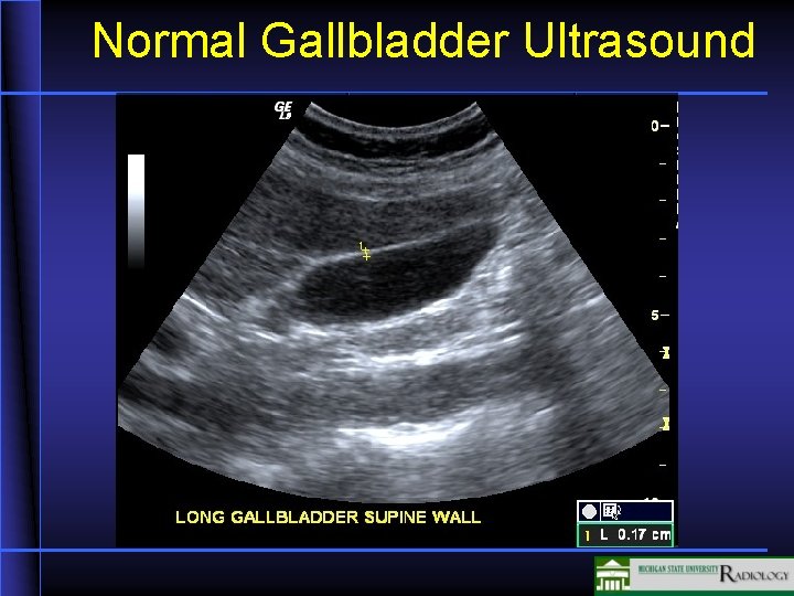 Normal Gallbladder Ultrasound 