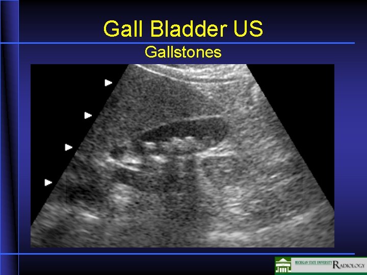 Gall Bladder US Gallstones 