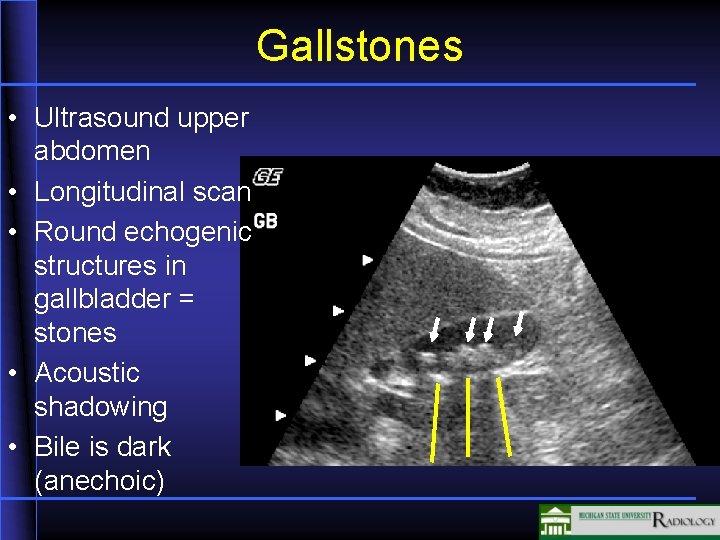 Gallstones • Ultrasound upper abdomen • Longitudinal scan • Round echogenic structures in gallbladder