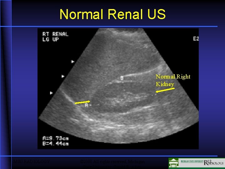 Normal Renal US Normal Right Kidney MSU RADIOLOGY © 2008 All rights reserved, Michigan