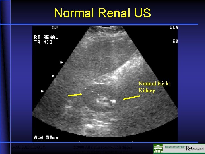 Normal Renal US Normal Right Kidney MSU RADIOLOGY © 2008 All rights reserved, Michigan