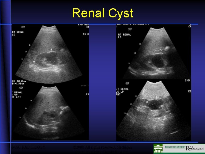 Renal Cyst MSU RADIOLOGY © 2008 All rights reserved, Michigan State University Gerald R.