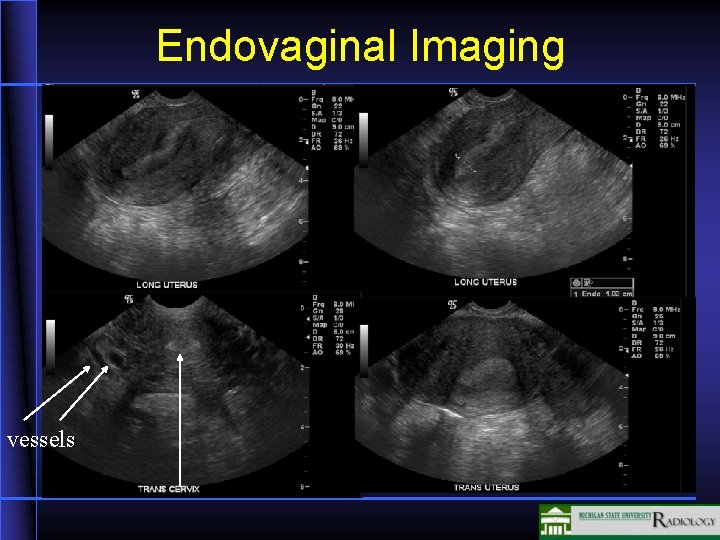 Endovaginal Imaging vessels 