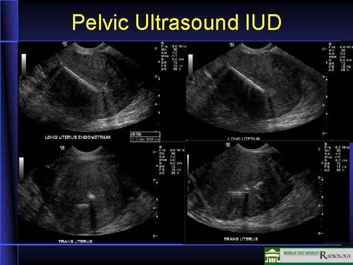 Pelvic Ultrasound IUD 