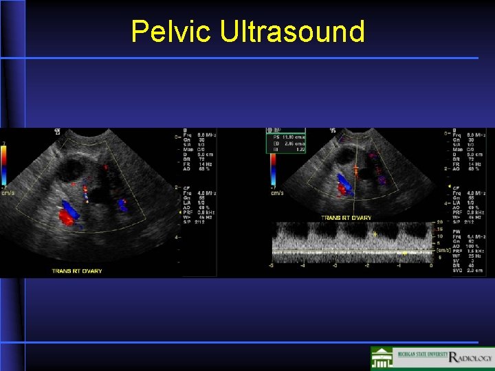 Pelvic Ultrasound 