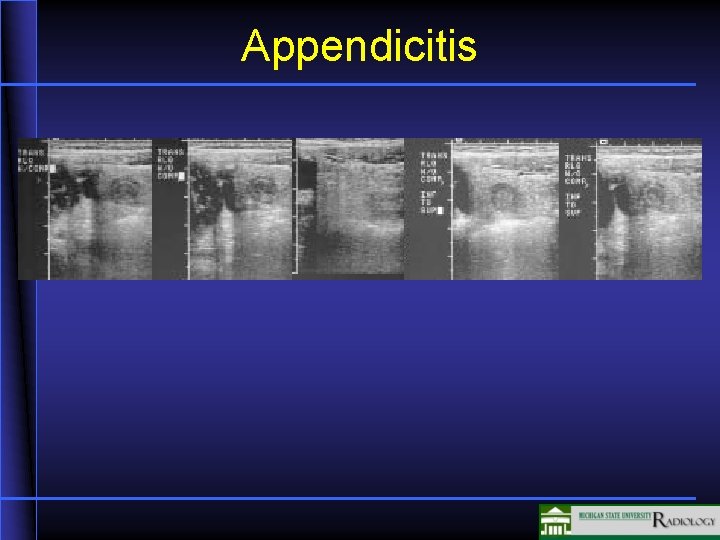 Appendicitis 