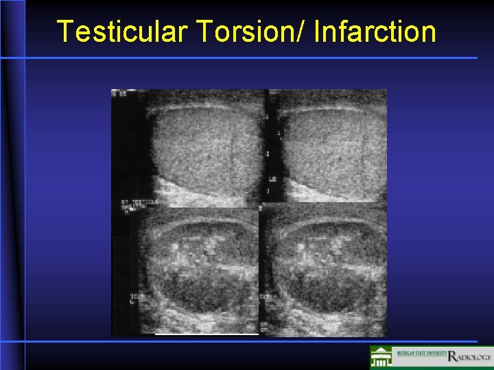 Testicular Torsion/ Infarction 